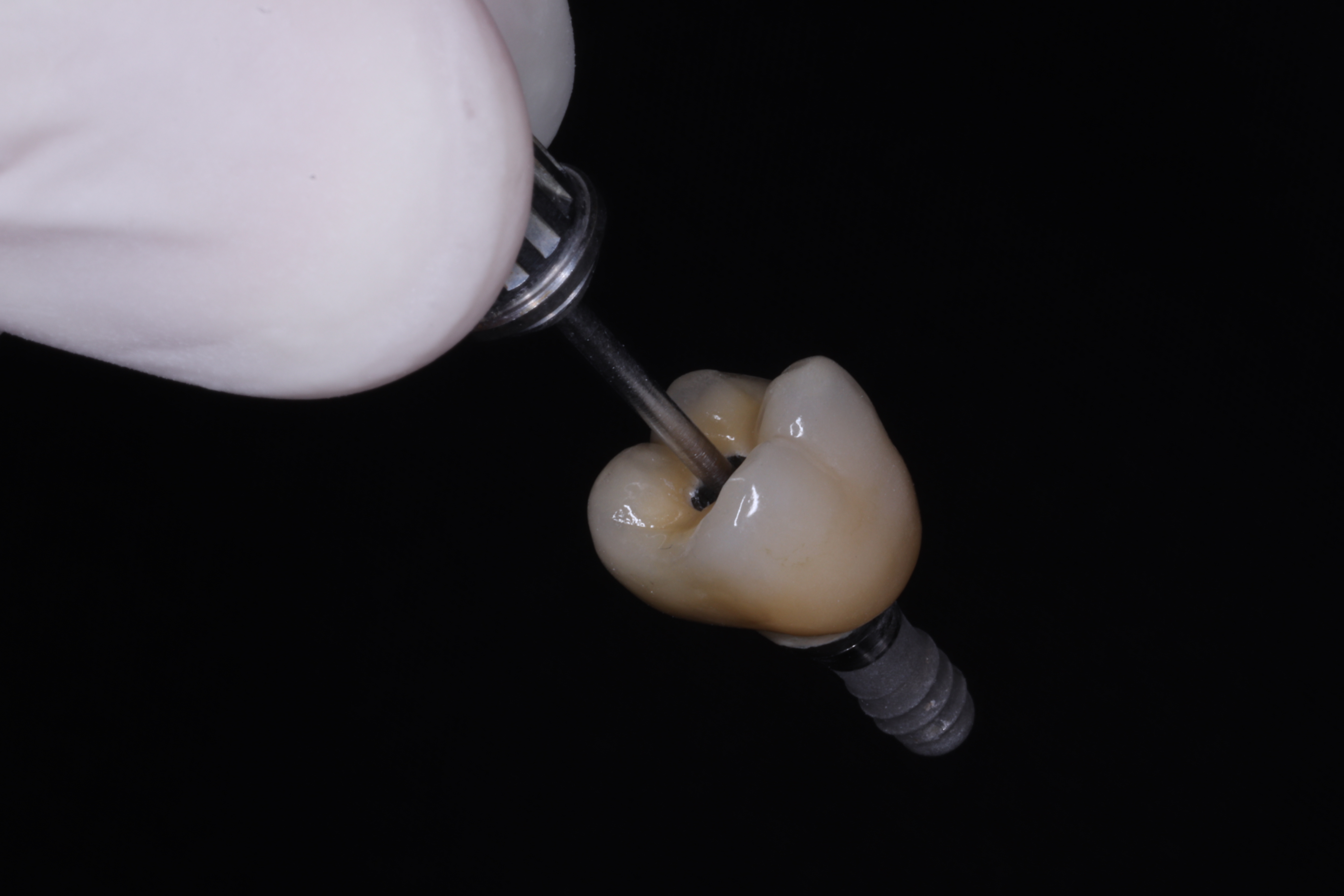 IMPLANTE DENTÁRIO WKR ODONTOLOGIA DENTISTA ZONA NORTE PORTO ALEGRE